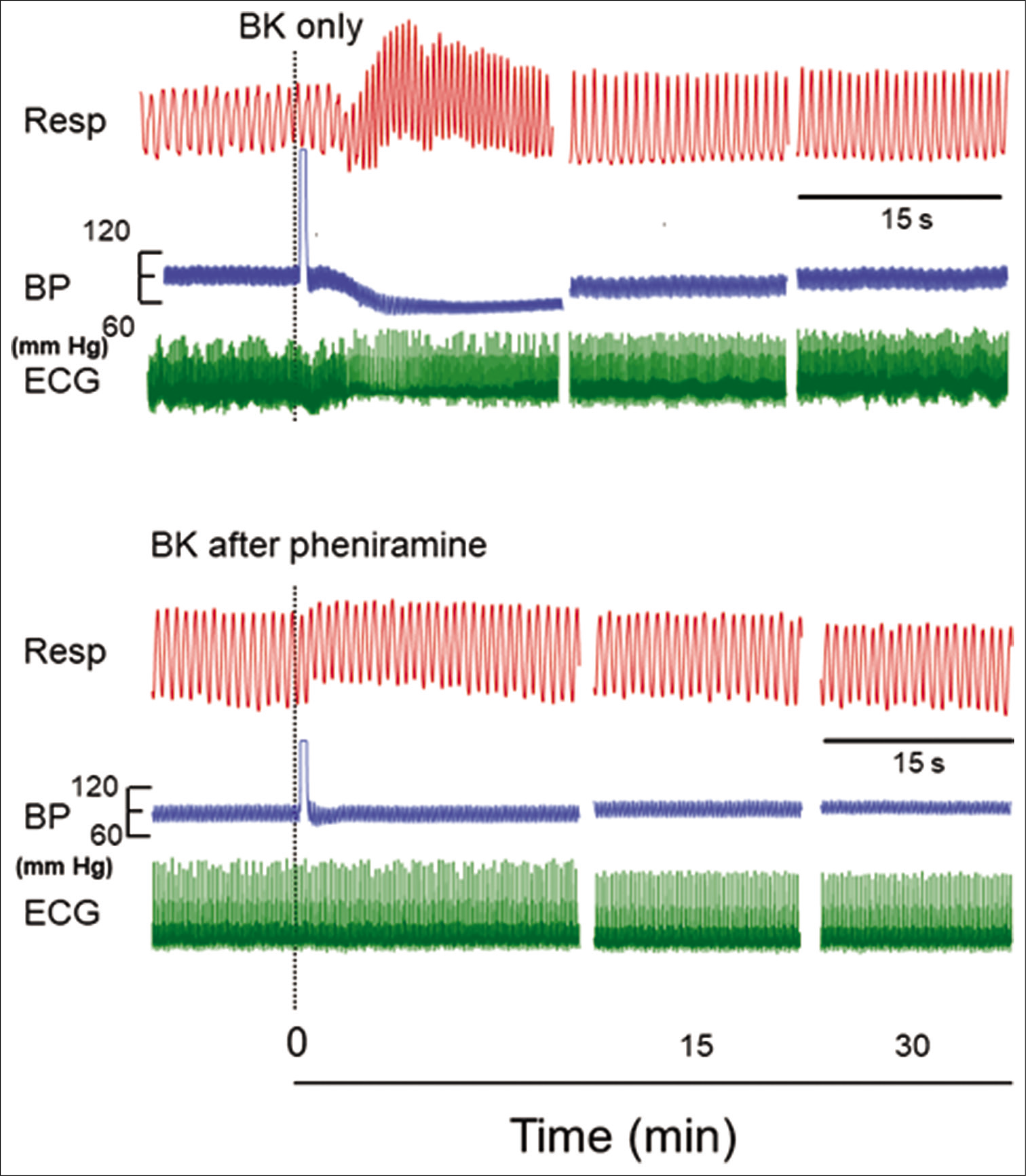 Original recordings showing the effect of injecting 1 µM concentration of bradykinin (BK) (0.10 ml) in a segment of femoral artery on respiration (Resp), blood pressure (BP), and electrocardiogram (ECG) in the naive and in pheniramine maleate pretreated rats. The responses after BK are shown at different time intervals as indicated in the lower panel. The point of injection is shown by dotted line. The horizontal line between Resp and BP indicates 15 s for all parameters.