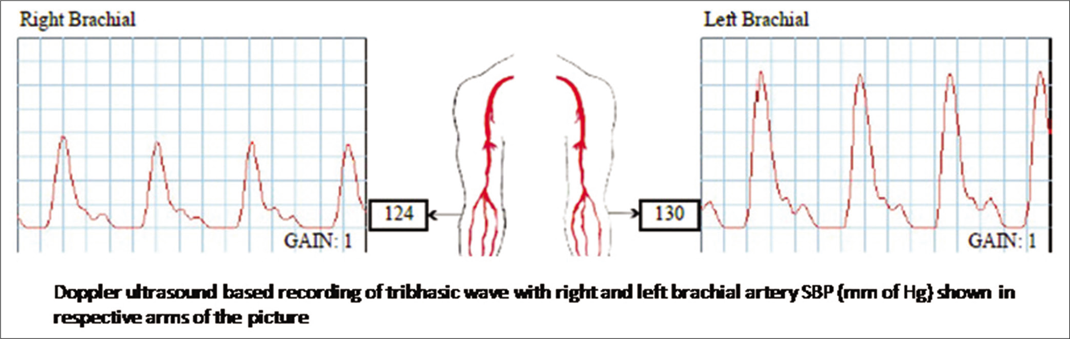 Representative record of triphasic wave in Doppler ultrasound based ABPI recording.