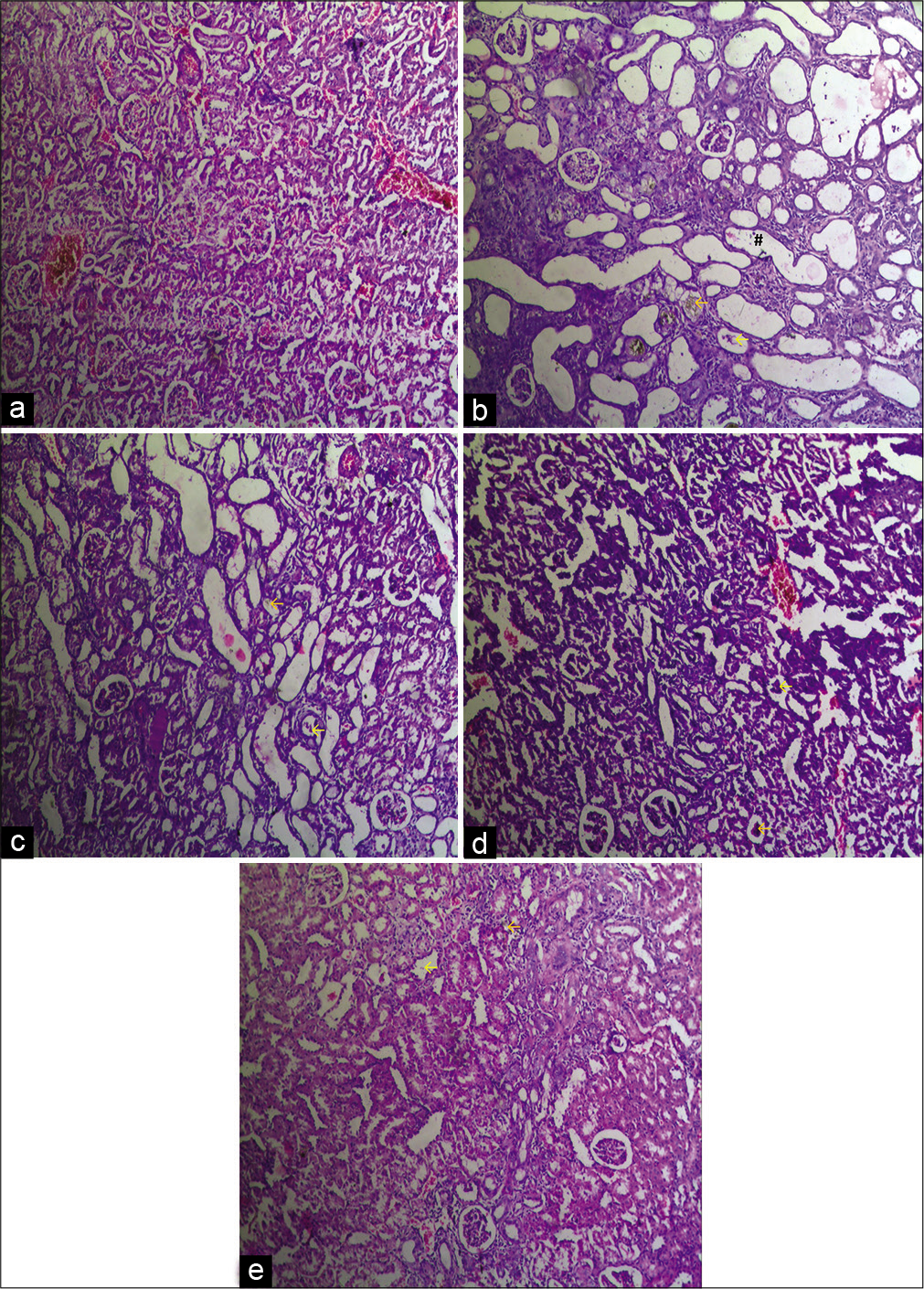 Effect of lycopene on kidney histopathological changes (H and E staining [×10]) in adenine-induced chronic renal failure in rat. (a) Normal control, (b) diseases control, (c) 100 mg/kg Lycopene+Adenine, (d) 200 mg/kg Lycopene+Adenine, (e) 400 mg/ kg Lycopene+Adenine. *: Degeneration of glomeruli; #: Dilated tubule; †: Thickening of bowman capsules; ←: Tubular atrophy; ←: Adenine crystal deposition; ←: Brush border loss of proximal tubule; ←: Inflammatory cells infiltration.