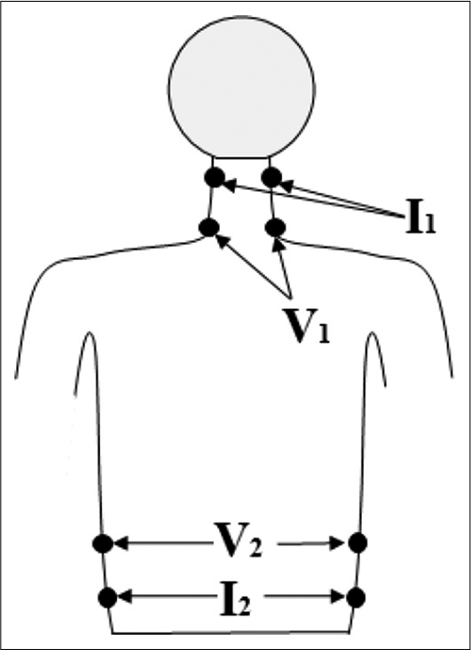 Placement of electrodes (I1, I2, V1, and V2) on the body surface for the determination of cardiac output.