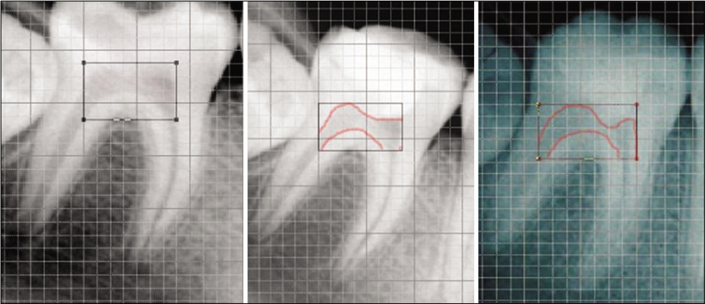 Digital quantitative analysis between immediate post-operative and after 12 month follow-up partially pulpotomized tooth.