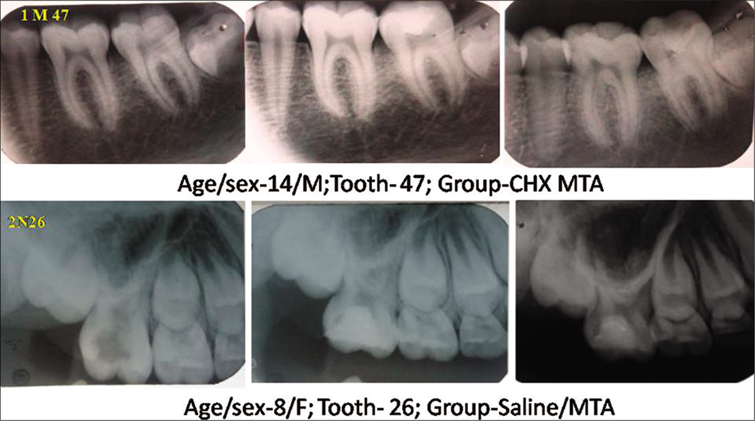 Representative radiographs of 12 months follow up after mineral trioxide aggregate partial pulpotomy with (Group 1) or without (Group 2) using 0.12% chlorhexidine gluconate.