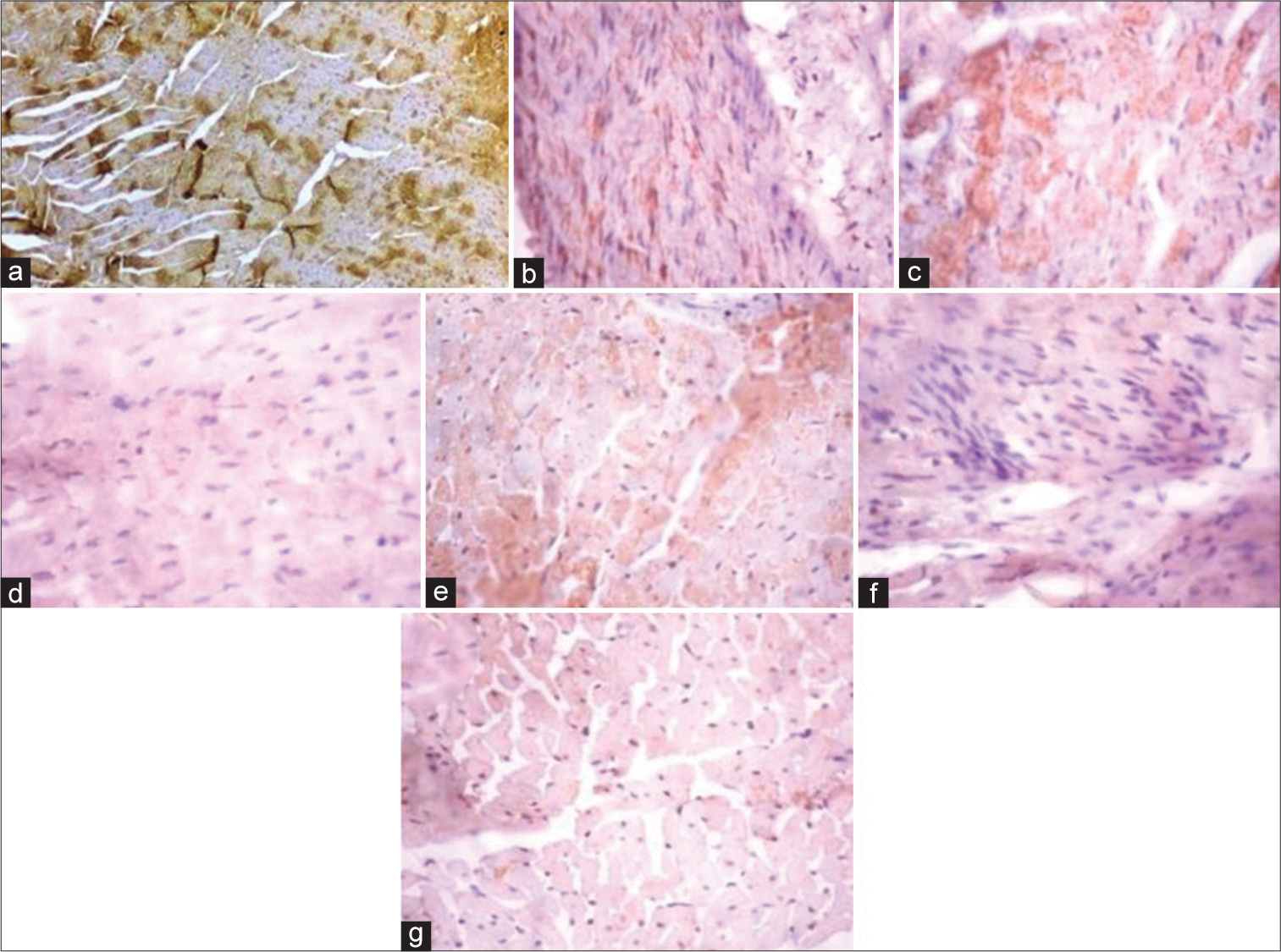 (Plate a-g): Photomicrograph of a heart section stained immunohistochemically for carnitine palmitoyltransferase 1β expression (×400). (a) (Control), (b) (BPA), (c) (DBP), (d) (BPA + Rt), (e) (DBP + Rt), (f) (BPA + DBP) and (g) (BPA + DBP + Rt). BPA: Bisphenol A, DBP: Dibutyl phthalate, Rt: Rutin.