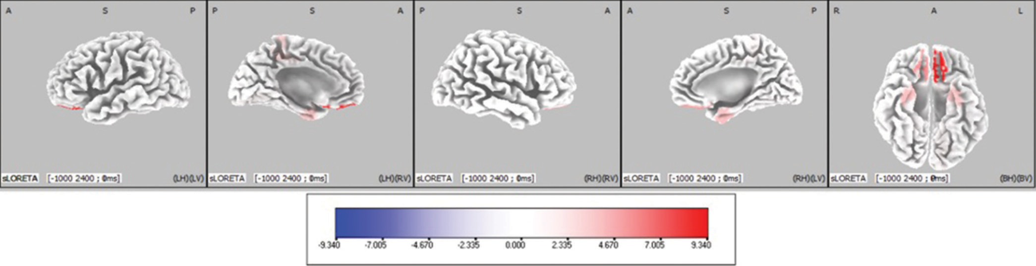 Cortical areas showing significantly different activity between Face-word interference (FwI) and Word-face interference (WfI) have been marked in orthogonal plots. Blue coloured areas indicate decreased activity in Face word interference task as compared to Word face interference. The scale provided measures the t-statistics based on SnPM analysis comparing the current source density in (nA/mm2) between FwI and WfI.