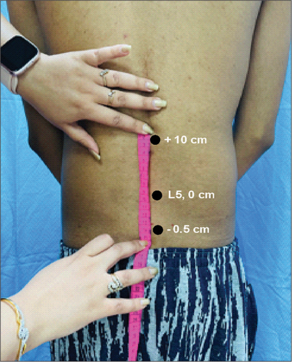 Schober’s test for lumbar flexion. L5 is marked first and then 15 cm from the −5 cm from L5 is the landmark that is investigated for lumbar flexion (+10 cm).