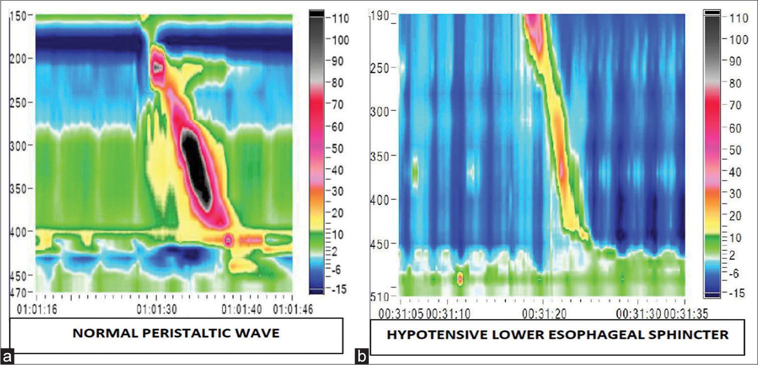 The colour plot obtained on high-resolution manometry depicts colour coded pressure topography during an oesophageal swallow. (a) The colour plot on the left is of a normal peristalsis, (b) while the one on the right shows hypotensive lower oesophageal sphincter.