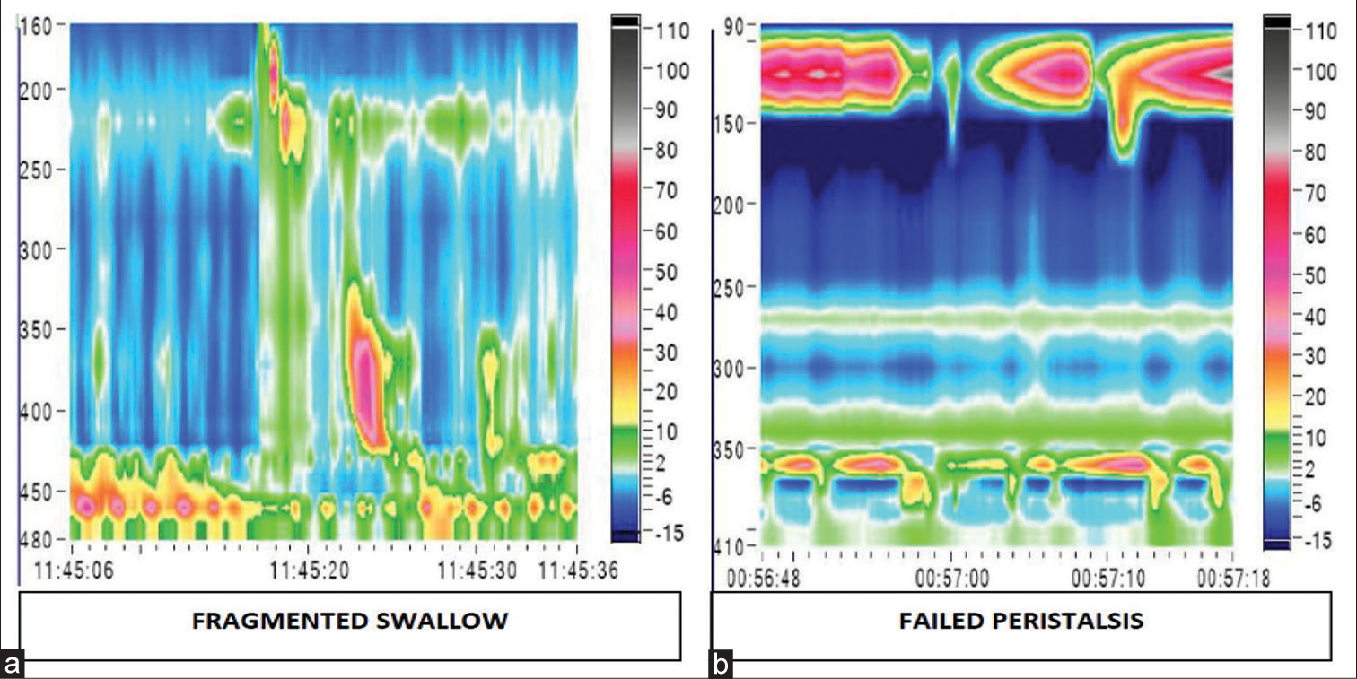 High-resolution manometry picture obtained in patients with oesophageal motility disorders in gastroesophageal reflux disease. (a) The colour plot on the left shows a fragmented swallow and (b) the one on the right shows failed peristalsis.