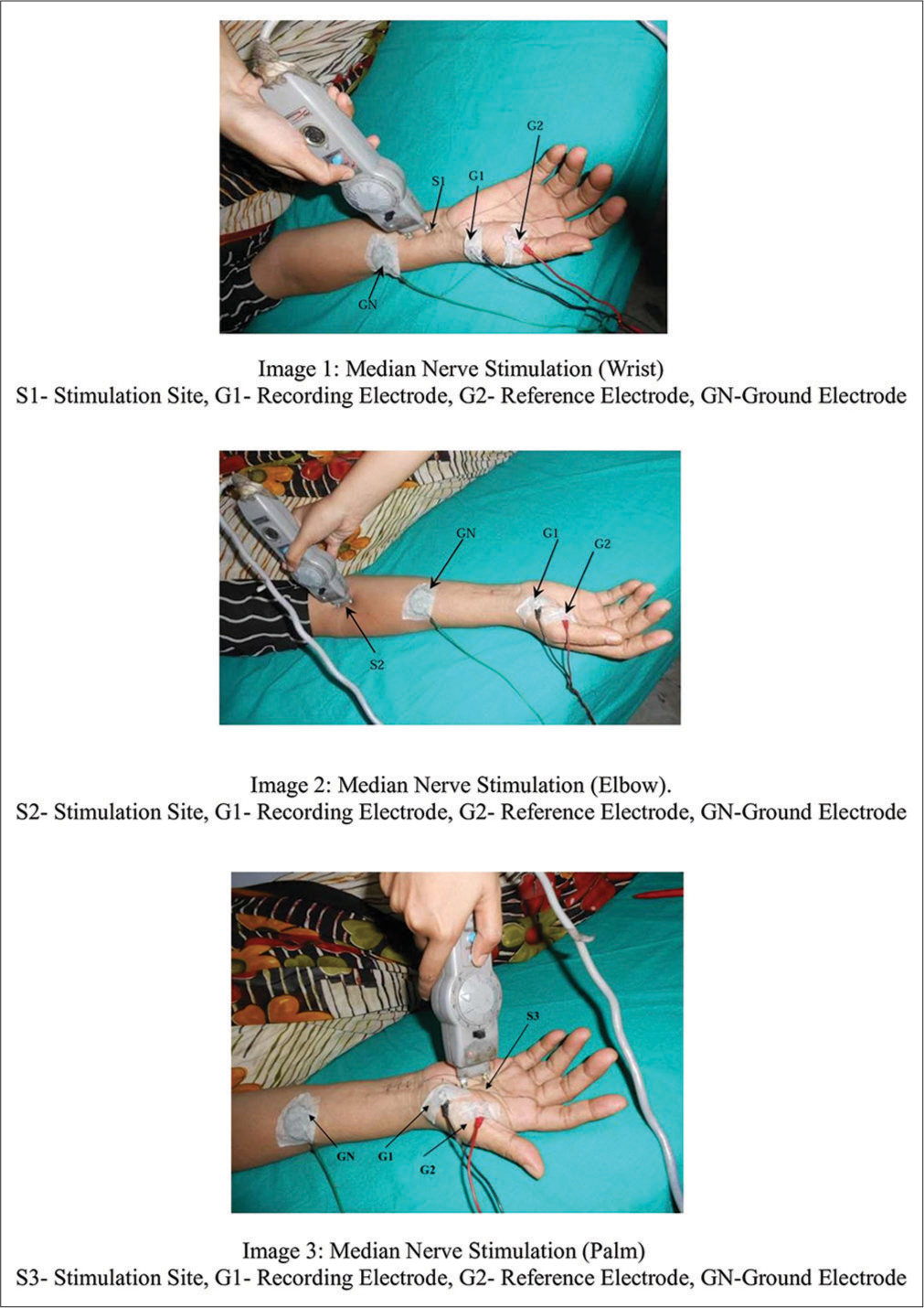 Median nerve – motor nerve conduction study.