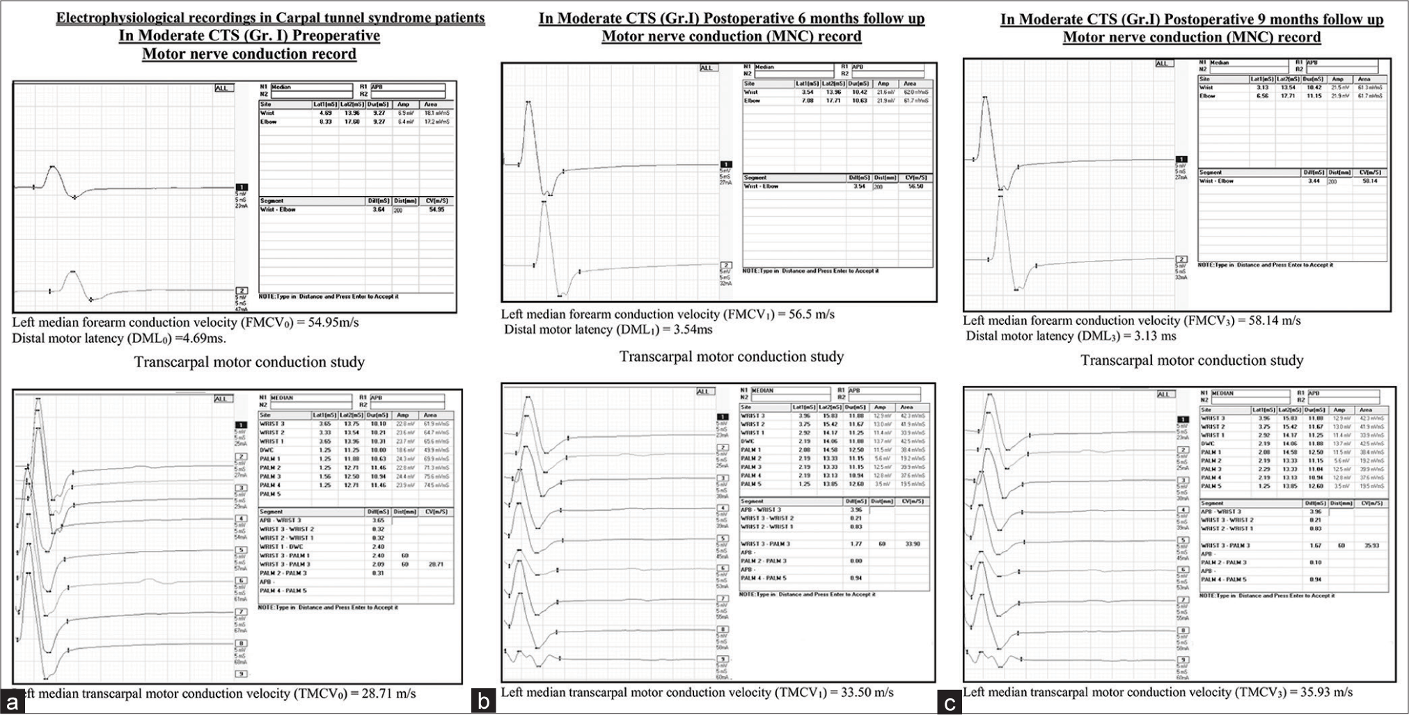 (a) Pre-operative NCS in Group I moderate CTS patients. (b) Post-operative 6 months NCS in Group I moderate CTS patients. (c) Post-operative 9 months NCS in Group I moderate CTS patients. NCS: Nerve conduction study, CTS: Carpal tunnel syndrome.