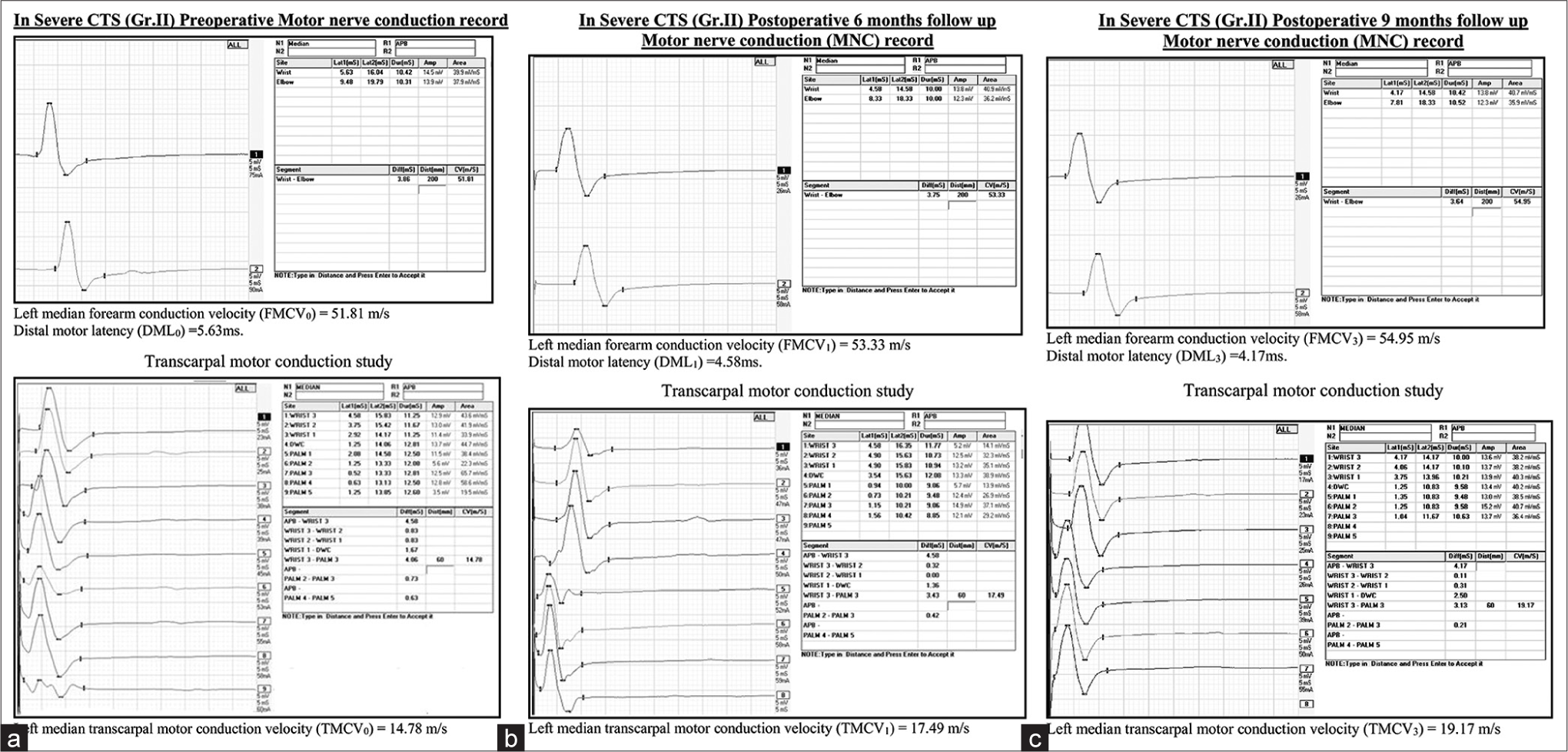 (a) Pre-operative NCS in Group II severe CTS patients. (b) Post-operative 6 months NCS in Group II severe CTS patients. (c) Post-operative 9 months NCS in Group II severe CTS patients. NCS: Nerve conduction study, CTS: Carpal tunnel syndrome.