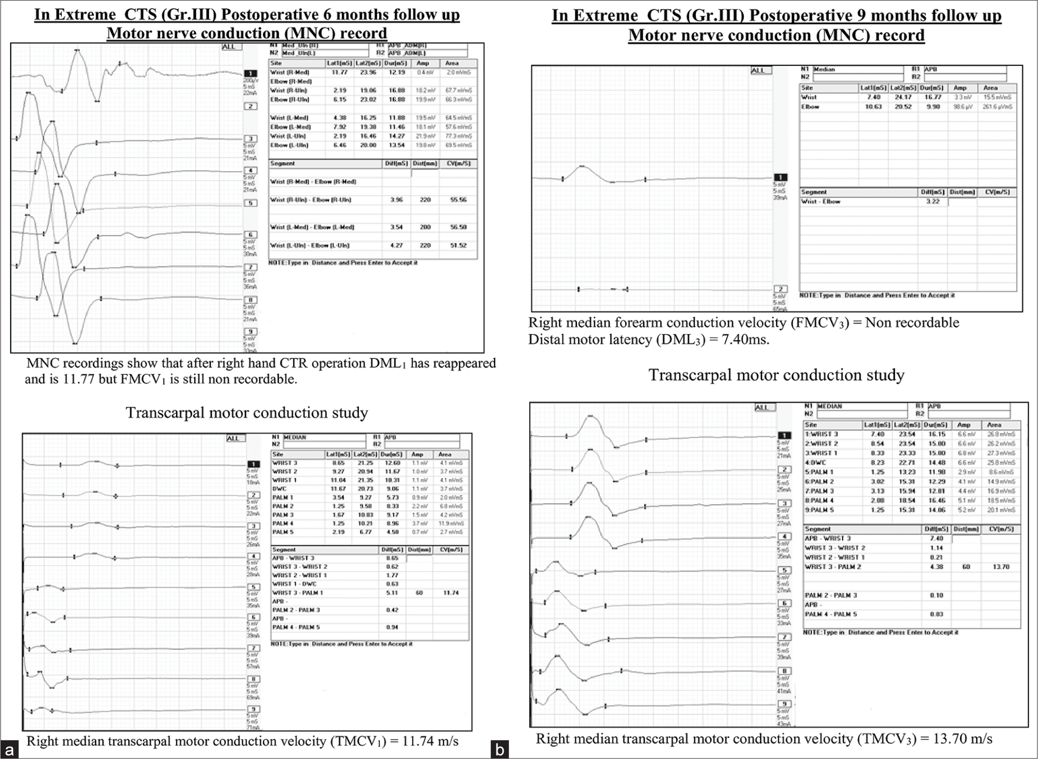 (a) Post-operative 6 months NCS in Group III extreme CTS patients. (b) Post-operative 9 months NCS in Group III extreme CTS patients. NCS: Nerve conduction study, CTS: Carpal tunnel syndrome. NCS: Nerve conduction study, CTS: Carpal tunnel syndrome.