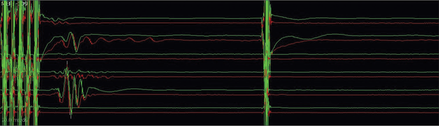 Double-train technique for establishing true corticobulbar facial motor-evoked potentials – responses noted only following train stimulation and not after a single pulse stimulation (Channels from top to bottom: frontalis, oculi_1, oculi_2, oris_upperlip, oris_lowerlip, masseter).