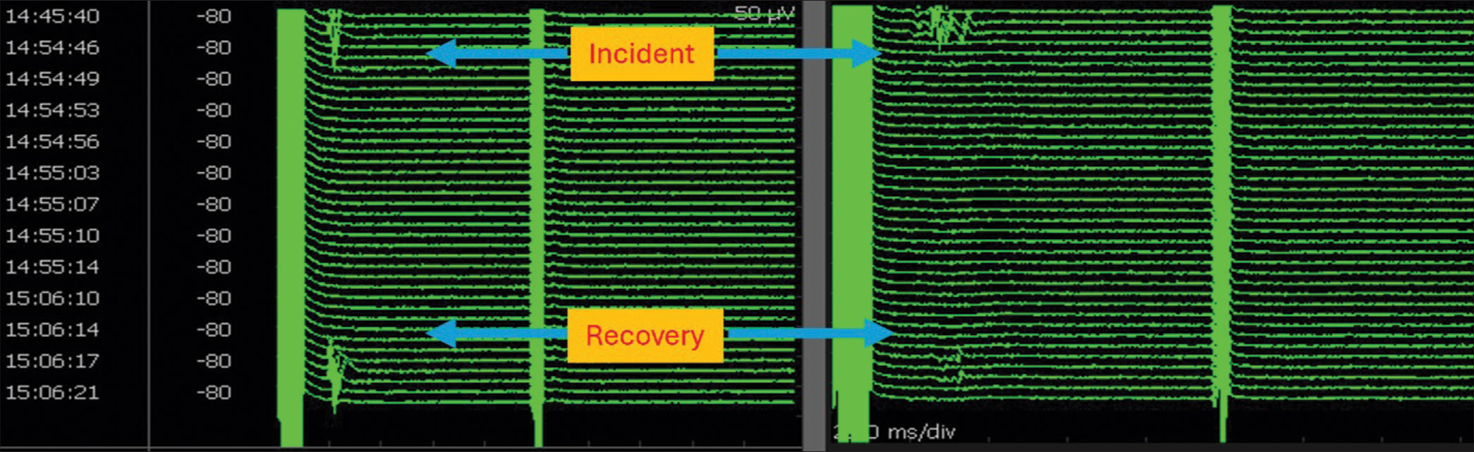 Stack view of facial motor-evoked potentials (FMEP) drop followed by recovery following bipolar cautery to arrest bleeding: illustrated channels are oculi (left) and oris (right). There were no concomitant neurotonic discharges. Note from the timestamp that it took about 12 min for the FMEP drop to recover. During this time, surgical pause was initiated, blood pressure was raised, and papaverine was irrigated. This is a classical illustration of the identification of an ongoing facial nerve injury at an early reversible stage using FMEPs and initiation of corrective measures resulting in near-total recovery. Surgery was resumed following recovery.
