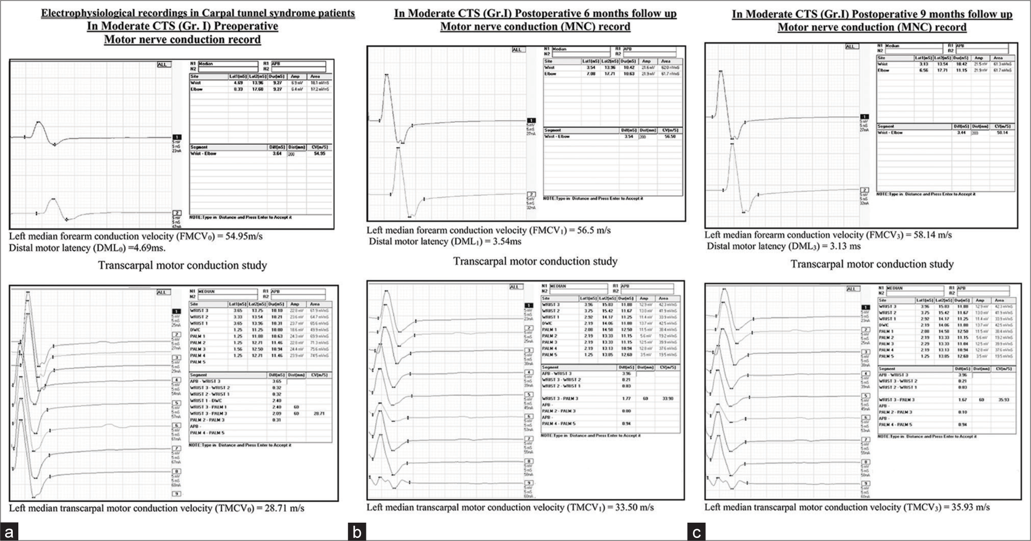 (a) Pre-operative NCS in Group I moderate CTS patients. (b) Post-operative 6 months NCS in Group I moderate CTS patients. (c) Post-operative 9 months NCS in Group I moderate CTS patients. NCS: Nerve conduction study, CTS: Carpal tunnel syndrome.