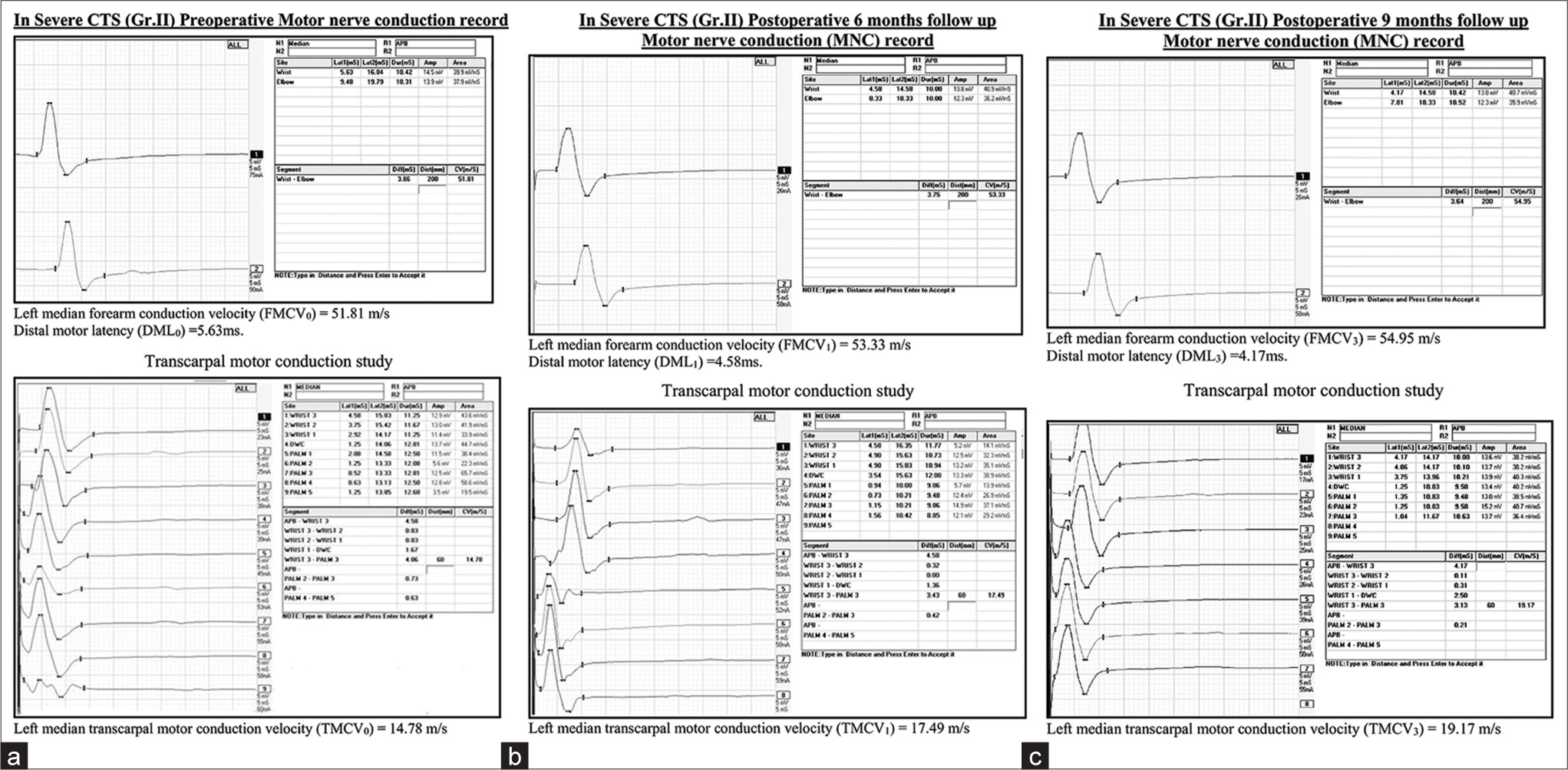 (a) Pre-operative NCS in Group II severe CTS patients. (b) Post-operative 6 months NCS in Group II severe CTS patients. (c) Post-operative 9 months NCS in Group II severe CTS patients. NCS: Nerve conduction study, CTS: Carpal tunnel syndrome.