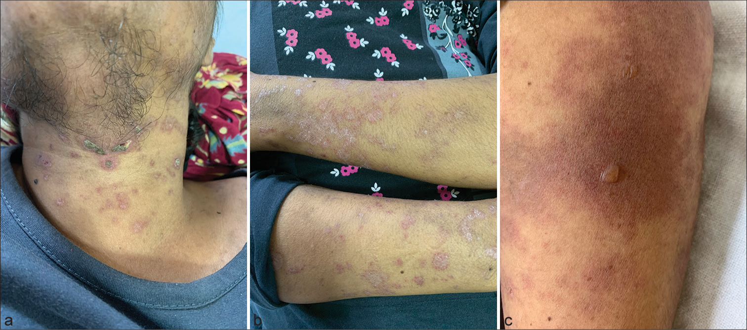 (a-b) Multiple, polycyclic, erythematous, mildly scaly, plaques distributed on photoexposed areas. (c) Single blister on erythematous plaque was seen on the left arm.