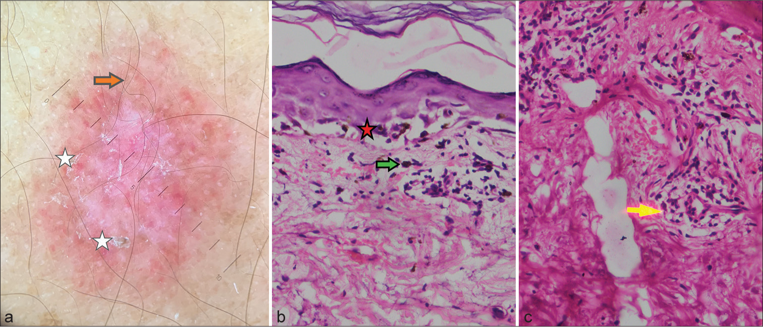 Dermoscopic examination revealing patchy white scales (white star) on pink red background and red structureless areas (red arrow) (a). (Heine Delta 20T dermatoscope, nonpolarized contact mode, ×0). Basal layer vacuolation (red star) and pigment incontinence (green arrow) (b), Lymphocytic infiltrate (yellow arrow) in the dermis (c) (H and E stain, ×40). H and E: Haematoxylin and Eosin.