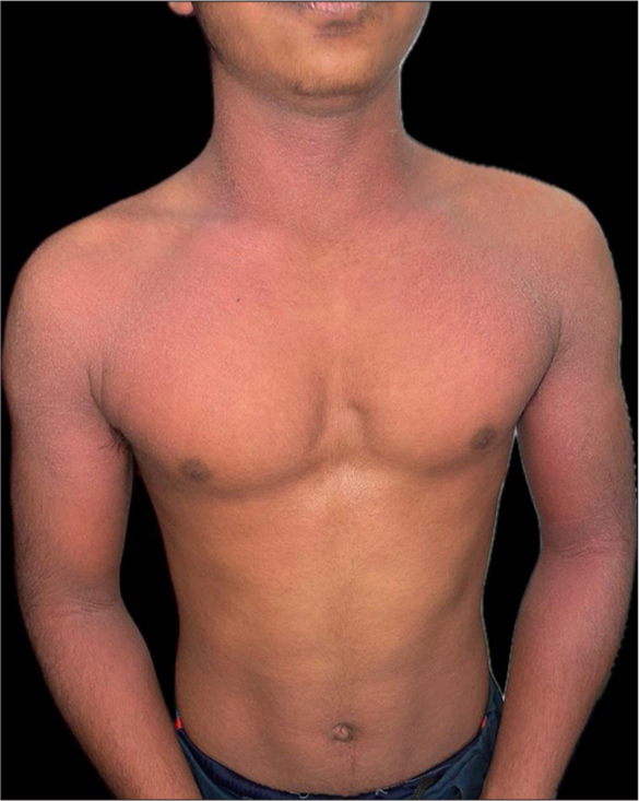 Erythematous scaly rash distributed symmetrically over chest, neck and arms.