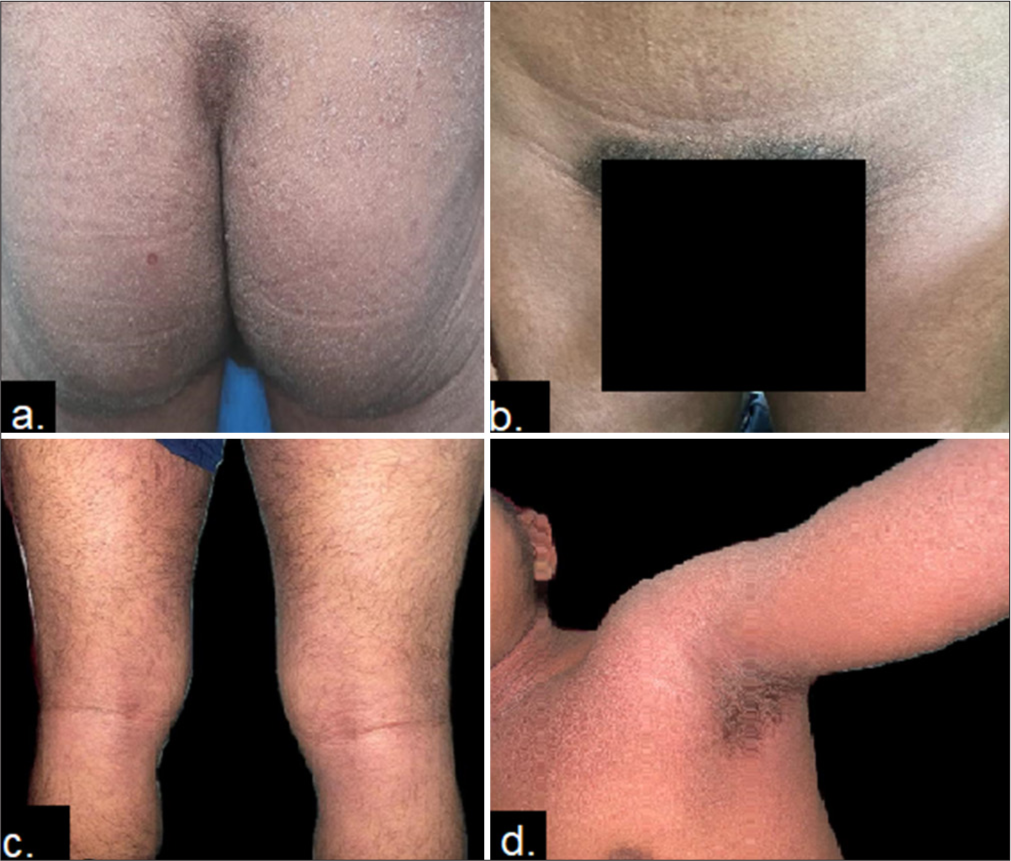 Erythematous scaly rash involving (a) buttocks, (b) groins, (c) popliteal fossa and (d) axilla.