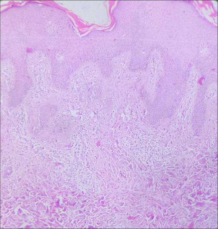 Histopathology showing hyperkeratosis, papillary oedema and non-specific perivascular inflammatory infiltrate [Hematoxylin and eosin (H & E) stain, ×10].