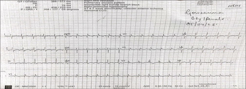 10th day electrocardiogram showing atrial flutter with 2:1 AV conduction. AV: Atrioventricular.