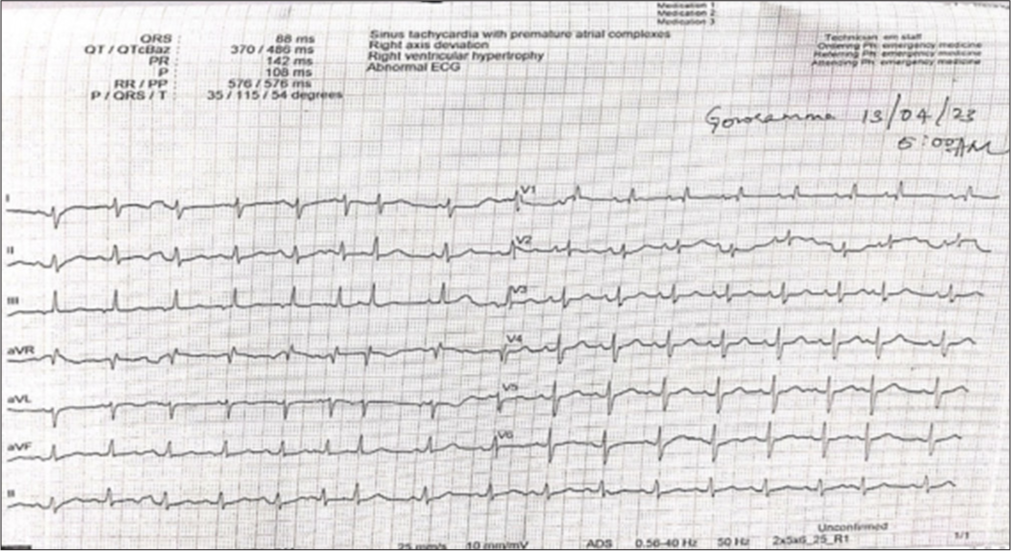 On 18th day electrocardiogram showing sinus tachycardia with premature atrial complexes.