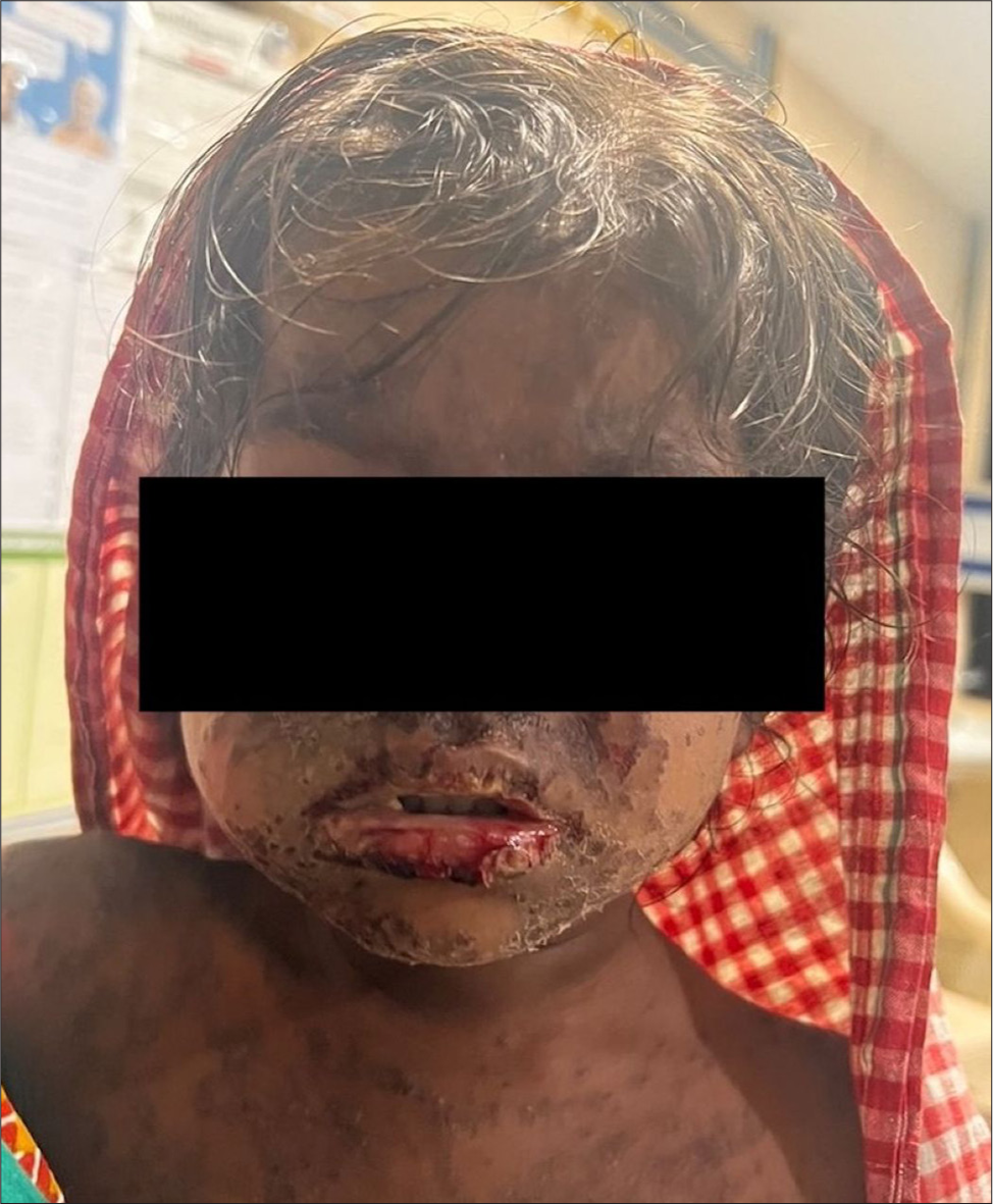 Phenytoin-induced toxic epidermal necrolysis (Case 1) – Vesicles over perioral region and chin with ulceration over the lips.