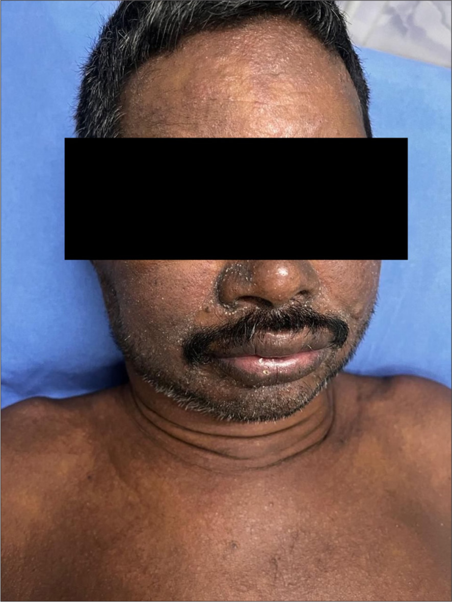 Acute generalised exanthematous pustulosis (AGEP) secondary to phenytoin (Case 4) – Patient with AGEP presenting with angioedema of the lips.