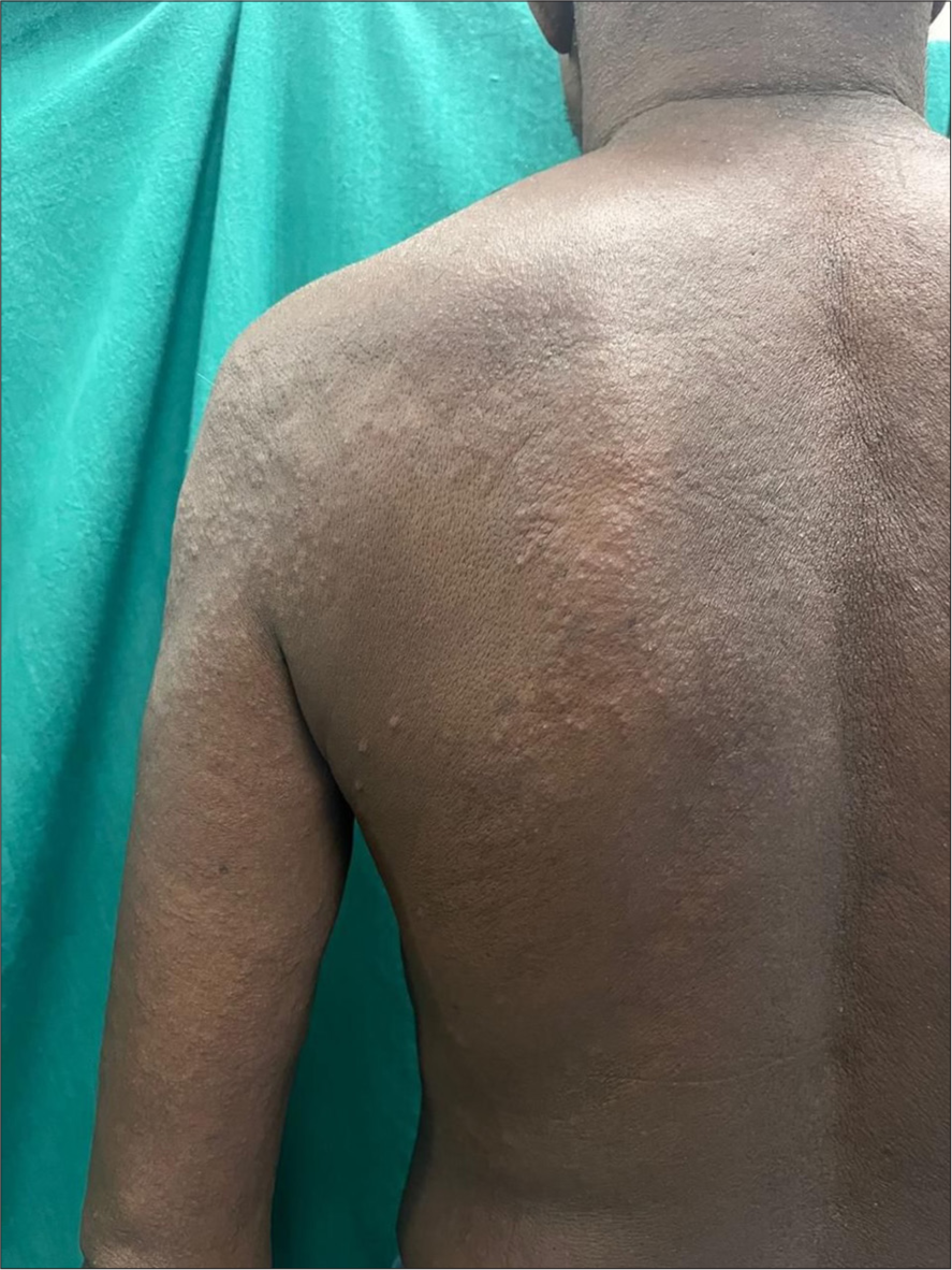 Acute generalised exanthematous pustulosis (AGEP) secondary to phenytoin (Case 4) – Patient with AGEP presenting with multiple erythematous papules and plaques over the back.